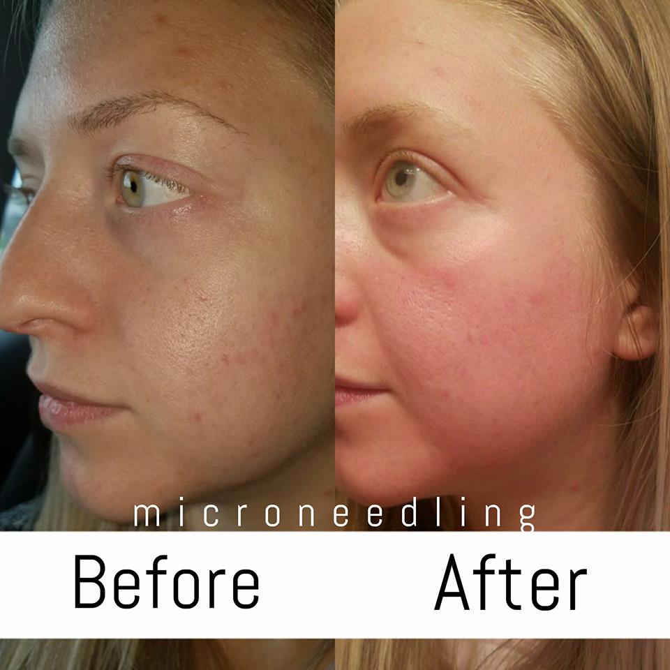 Microneedling creates microscopic holes in the skin, allowing your skin to heal itself. By doing so, your skin naturally creates more collagen which lifts and tightens your skin while removing spots, scarring, and wrinkles. Learn more about my experience with it.